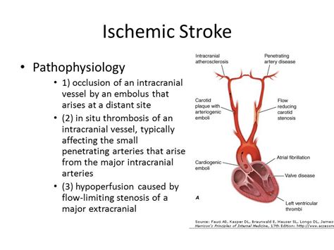 Ischemic Stroke Pathophysiology Yahoo Image Search Results Video