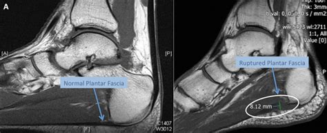 The purpose of this study was to investigate the relationship of muscle mri findings and gait all dm1 patients presenting with foot drop showed high intensity signals in the tibialis anterior muscles on. Plantar Fascia Tear | Mr Malik Orthopaedic Consultant