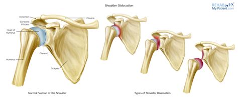 Shoulder Dislocation Rehab My Patient
