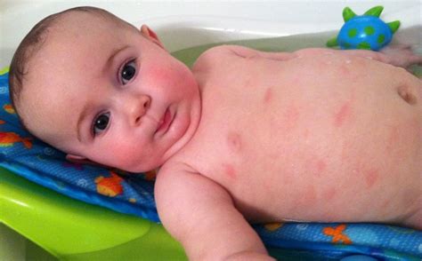 Urticaria En Bebés Y Recién Nacidos 12 Fotos Síntomas Y Tratamiento