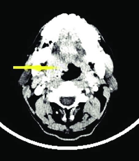 Computed Tomography Scan Face And Neck Axial Image Showing A Poorly