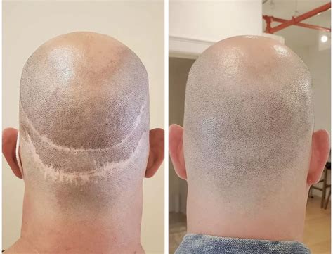 Hair Transplant Scar Healing Time Heinous Web Log Picture Archive