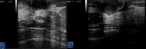 Bilateral Subareolar Abscesses Ecr 2014 Case Of The Day Eurorad