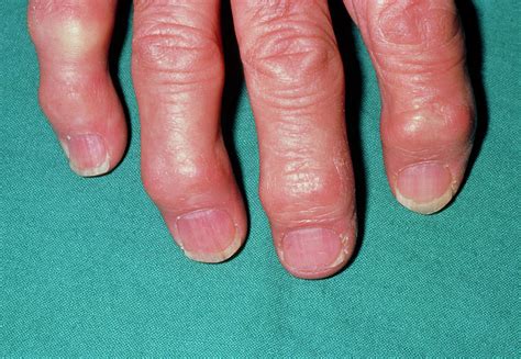 Arthritic Hand Showing Heberdens Nodes On Fingers Photograph By Dr P