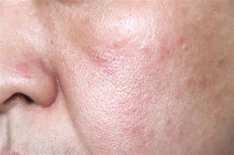 Allergic Reaction Rash On Face And Neck If Your Dermatologist Or