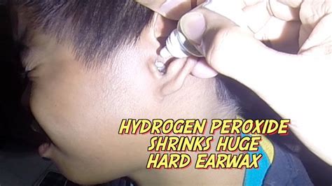 Hydrogen peroxide is fantastic, but do you know all of its uses? Hydrogen Peroxide Shrinks Huge Hard Earwax - YouTube
