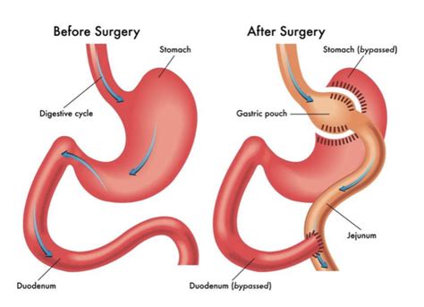Roux En Y Gastric Bypass Rygb Surgery The Endocrine Doc