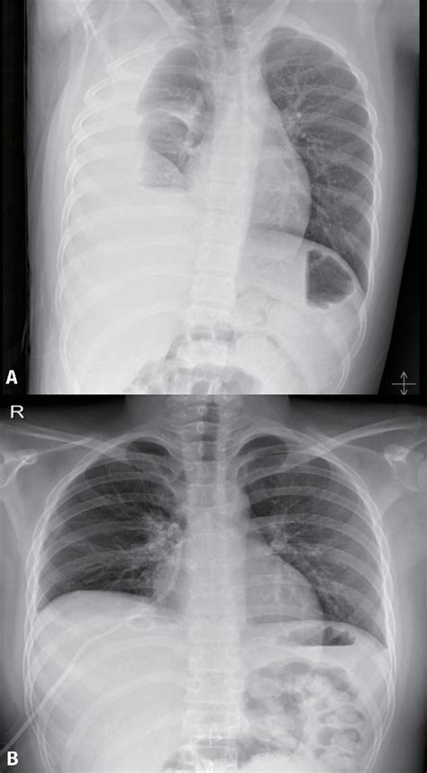 Pleural infection pleural inflammation pleural malignancy (most often occurring with the lung or breast) pneumonia pulmonary pleural fluid analysis findings: (A) Chest X-ray taken on hospital day 21 showing pleural ...