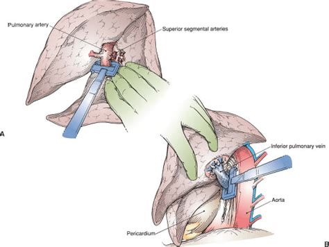 Cervical Lymph Node Biopsy And Scalene Node Biopsy Basicmedical Key