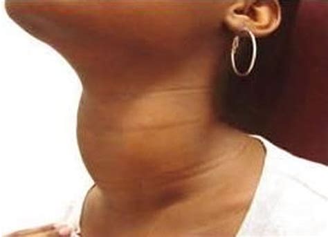 Enlarged Swollen Thyroid Symptoms Causes Treatment Pictures