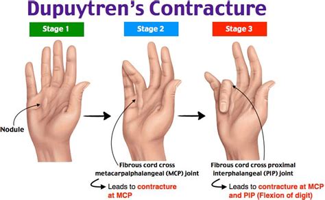 Duputryns Contracture Usa Spine Care And Orthopedics