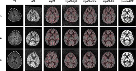 Frontiers Using Perfusion Contrast For Spatial Normalization Of Asl