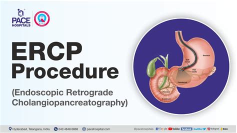 What Is Ercp Test And How It Is Done Department Of Gastroenterology