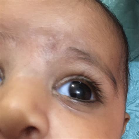 White Spots On Forehead