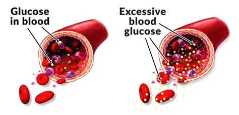 Diabetes And Blood Sugar How To Relief