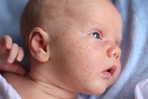 Understanding Baby Acne And How To Treat It Baby Chick