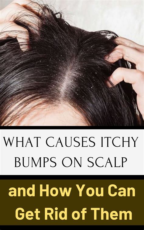 What Causes Itchy Bumps On Scalp And How You Can Get Rid Of Them