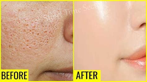In Just 3 Days Reduce Large Open Pores Permanently Open Pores