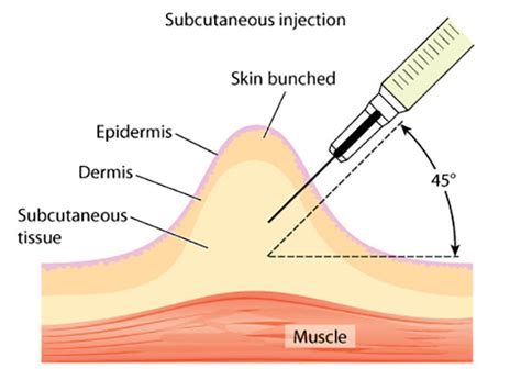 Subkutane Injektion Anleitung Durchführung Komplikationen
