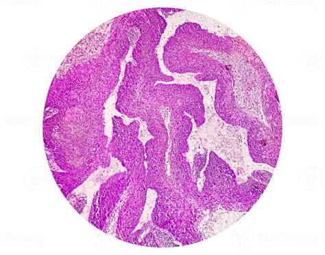 Photomicrograph Showing Tongue Squamous Cell Carcinoma Grade Ii Oral