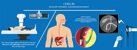 Endoscopic Retrograde Cholangio Pancreatography Ercp Gastrohealth