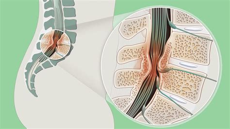 Physical Therapy Can Help Spinal Stenosis Elite Pt And Balance