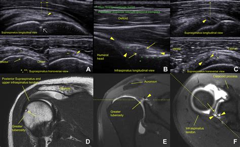 Supraspinatus Ultrasound View A Of The Cortical Impingement Cyst My