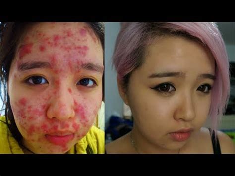 Human skin is covered in hundreds of thousands of microscopic hair follicles, often called pores, that connect to oil glands located under the skin. From Severe Acne to Clear Skin - YouTube