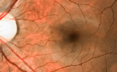 High Risk For Stroke In Patients With Recent Retinal Artery Occlusion