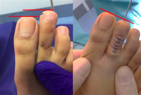 Toe Shortening Surgery Is A Real Thing And More Common Than Youd Think