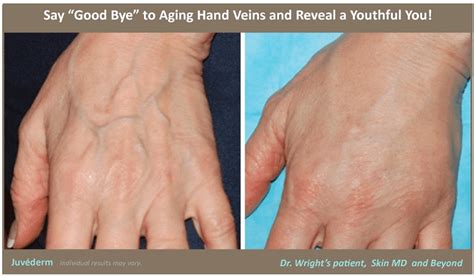 Hand Rejuvenation Prominent Veins Cosmetic Skin Care Specialist