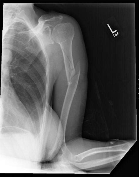 broken bone x ray images : Biological Science Picture Directory