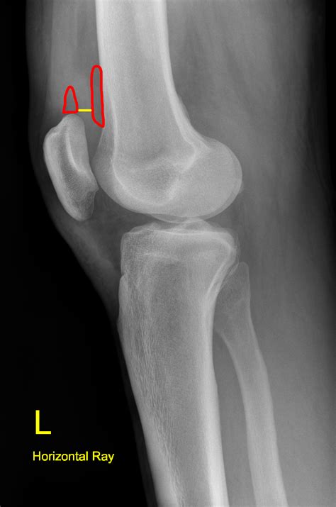 Knee Joint Effusions Are Only Reliably Seen On Lateral Projections The