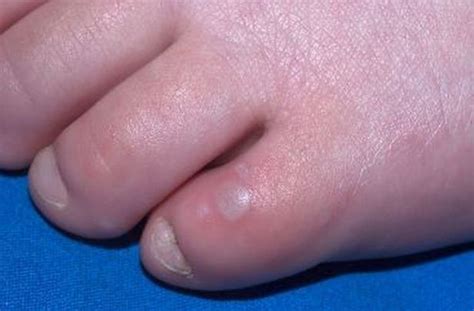 Hand Foot And Mouth Disease How To Spot The Signs And What To Do If