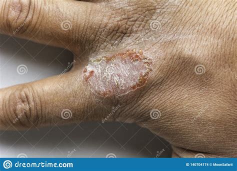 Hand With Atopic Dermatitis Eczema Psoriasis Vulgaris Stock Photo