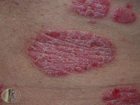Tiny Red Itchy Spots On Skin Jameslemingthon Blog