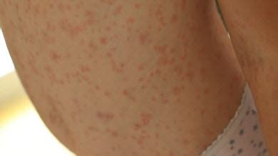 🌞 il est fort à parier que votre bout d'chou est en train de faire des boutons de chaleur. La roséole