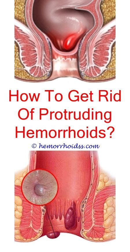 pin on hemorrhoids cure