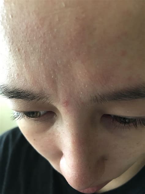 Skin Concerns Im Getting These White Flakes In The Morning After