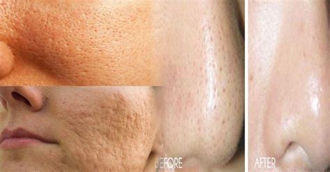 Enlarged Pores On Your Skin Can Cause Your Face Look Aged And Weak