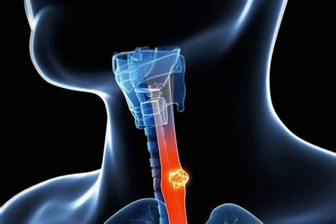 Foot pain is common as it has a wide range of contributing factors, including uncomfortable shoes, too much time standing, athletic injuries, and chronic conditions, such as arthritis. Food Pipe Cancer - Cancer Pain-India