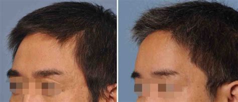 Forehead Augmentation Archives