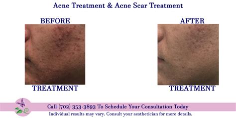 Acne Treatment And Acne Scar Therapy Shannons Serendipity Skincare
