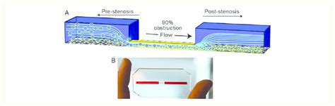 Microfluidic Studies Of Arterial Stenosis A Schematic Representation