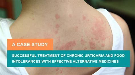 Successful Treatment Of Chronic Urticaria And Food Intolerances With