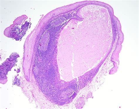 Mucous Cyst Histology