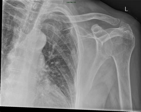 X Ray Shoulder