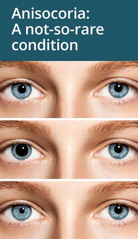 86 Best Eye Conditions Images On Pinterest Eye Facts Health And