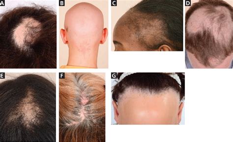 Male And Female Pattern Hair Loss Treatable And Worth Treating Cleveland Clinic Journal Of