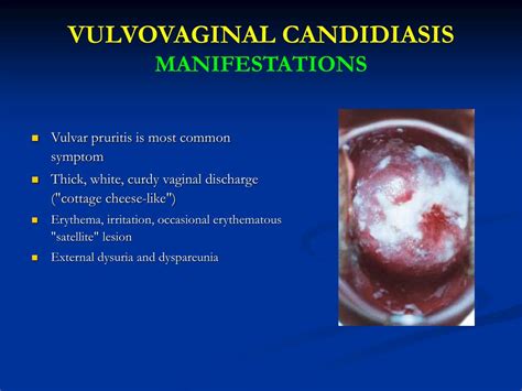 Clinicomycological Study Of Vulvovaginal Candidiasis Hot Sex Picture